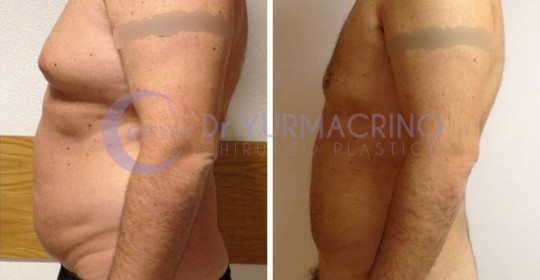 Liposcultura Uomo – Caso 2/C