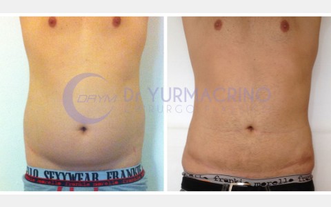 Liposcultura Uomo – Caso 3/A