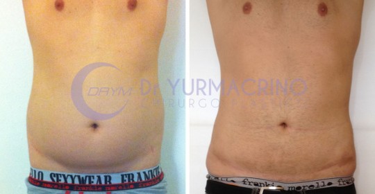 Liposcultura Uomo – Caso 3/A