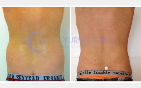 Liposcultura Uomo – Caso 3/B