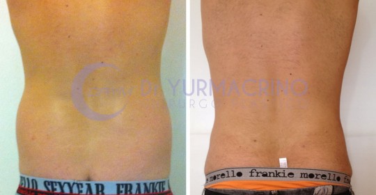 Liposcultura Uomo – Caso 3/B