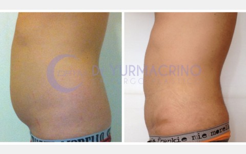 Man Liposculpture – Case 3/C