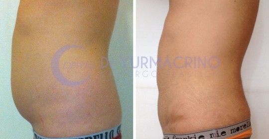 Liposcultura Uomo – Caso 3/C