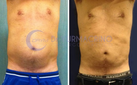 Liposcultura Uomo – Caso 4/A