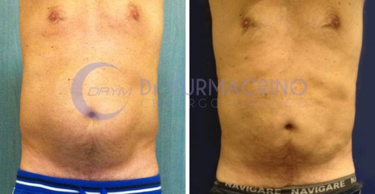 Liposcultura Uomo – Caso 4/A