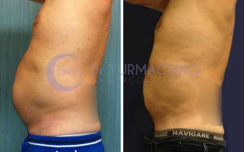 Man Liposculpture – Case 4/B