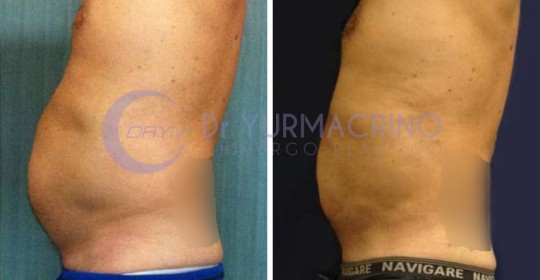 Liposcultura Uomo – Caso 4/B