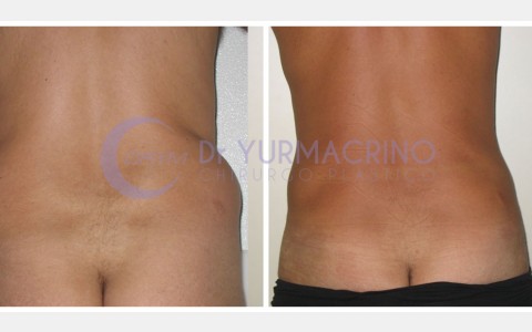 Man Liposculpture – Case 5