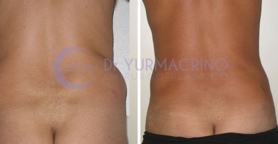 Liposcultura Uomo – Caso 5