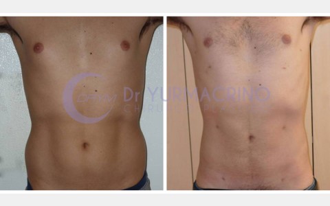 Man Liposculpture – Case 6/A