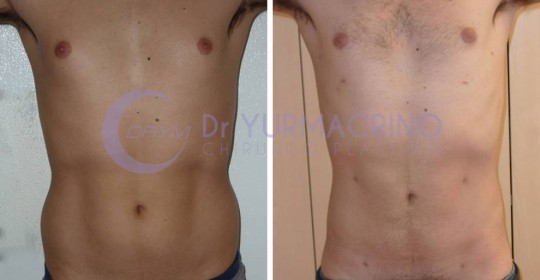 Liposcultura Uomo – Caso 6/A