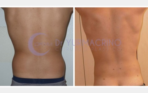 Liposcultura Uomo – Caso 6/B