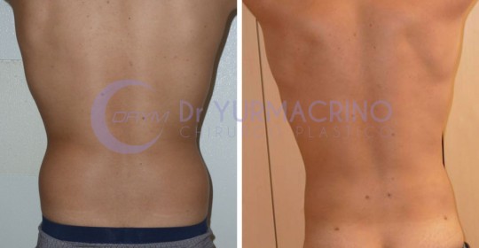 Man Liposculpture – Case 6/B