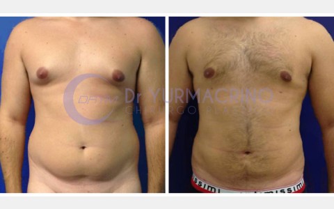 Man Liposculpture – Case 7/A