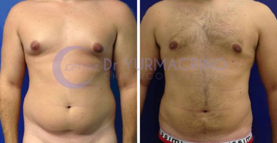 Liposcultura Uomo – Caso 7/A