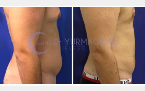 Man Liposculpture – Case 7/B