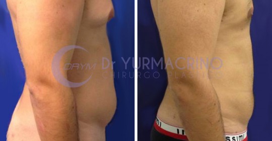 Liposcultura Uomo – Caso 7/B