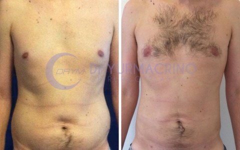 Liposcultura Uomo – Caso 8/A