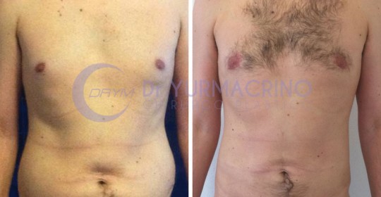 Liposcultura Uomo – Caso 8/A