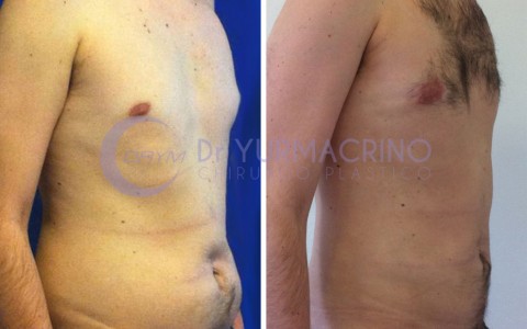 Man Liposculpture – Case 8/B