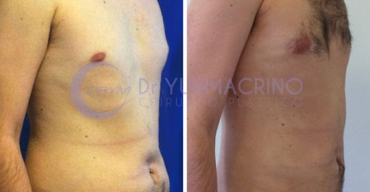 Liposcultura Uomo – Caso 8/B