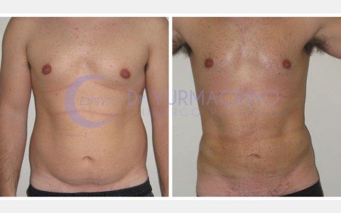 Man Liposculpture – Case 9