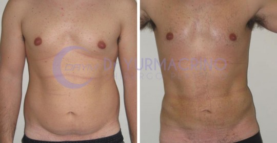 Liposcultura Uomo – Caso 9