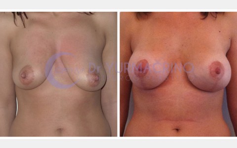 Mastopexy with Implants – Case 1/A