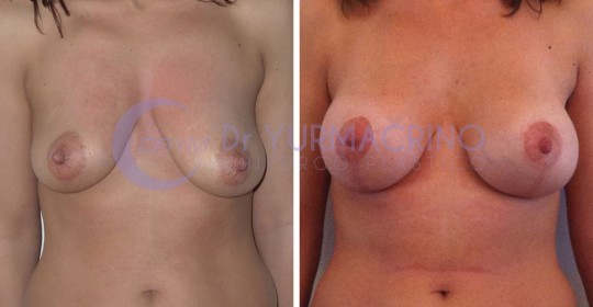 Mastopexy with Implants – Case 1/A