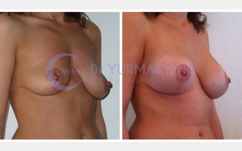 Mastopexy with Implants – Case 1/B