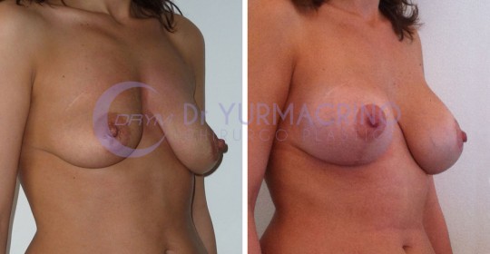 Mastopexy with Implants – Case 1/B