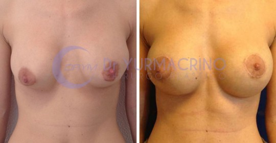 Mastopexy with Implants – Case 2/A