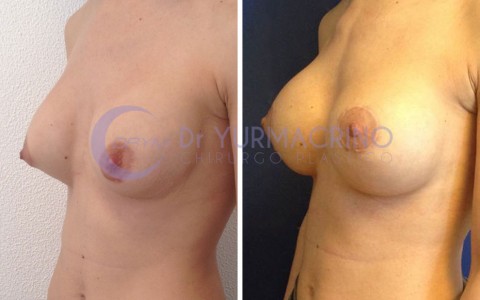 Mastopexy with Implants – Case 2/B