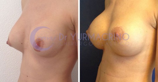 Mastopexy with Implants – Case 2/B