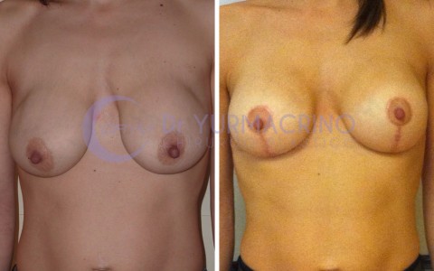 Mastopexy with Implants – Case 3/A