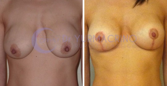 Mastopexy with Implants – Case 3/A