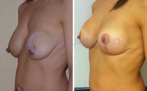 Mastopexy with Implants – Case 3/B