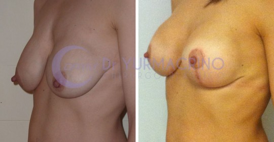 Mastopexy with Implants – Case 3/B