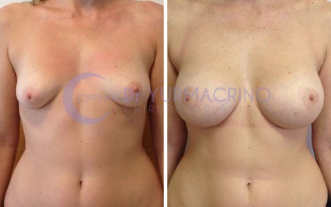 Mastopexy with Implants – Case 4/A