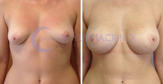 Mastopexy with Implants – Case 4/A
