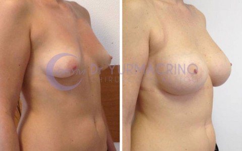 Mastopexy with Implants – Case 4/B