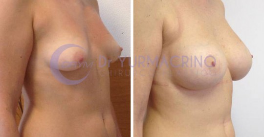 Mastopexy with Implants – Case 4/B