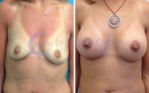 Mastopexy with Implants – Case 5/A