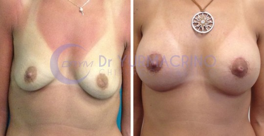 Mastopexy with Implants – Case 5/A