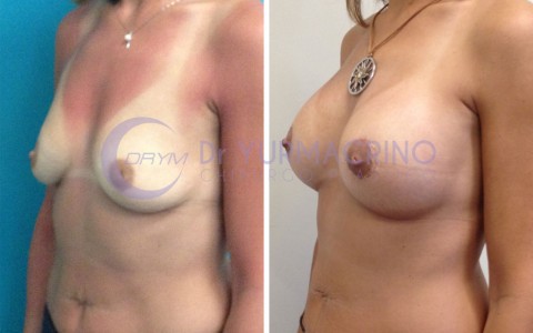 Mastopexy with Implants – Case 5/B