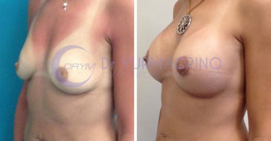 Mastopexy with Implants – Case 5/B