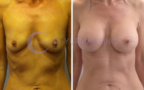 Mastopexy with Implants – Case 6/A