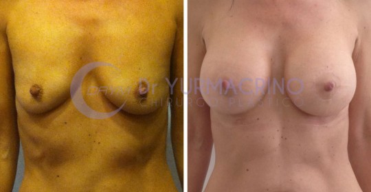 Mastopexy with Implants – Case 6/A