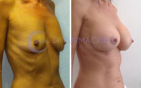 Mastopexy with Implants – Case 6/B