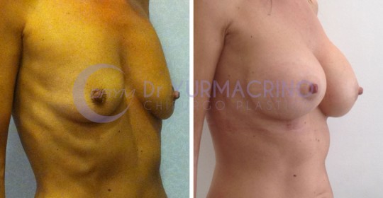 Mastopexy with Implants – Case 6/B